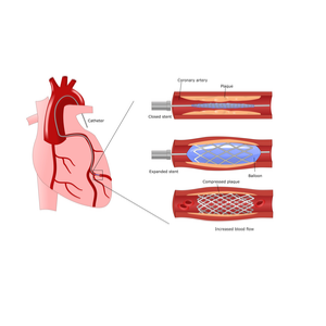 stent placement in a coronary artery