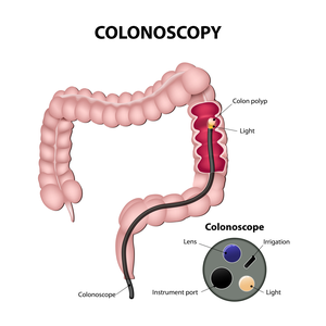 Colonoscopy explained diagram