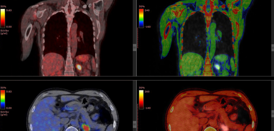 pet ct scan of brain