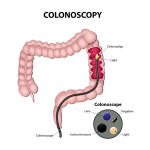 How Much Does a Colonoscopy Cost? (2022)