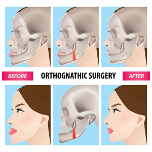 Jaw surgery - before and after picks