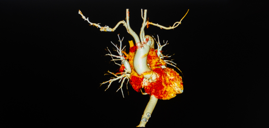 ct angiography