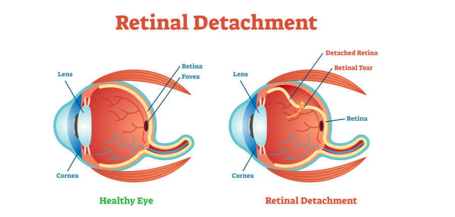 Retinal detachment vector diagram
