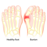 How Much Does a Bunion Surgery Cost? (2024)