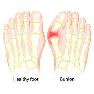 bunion feet before and after