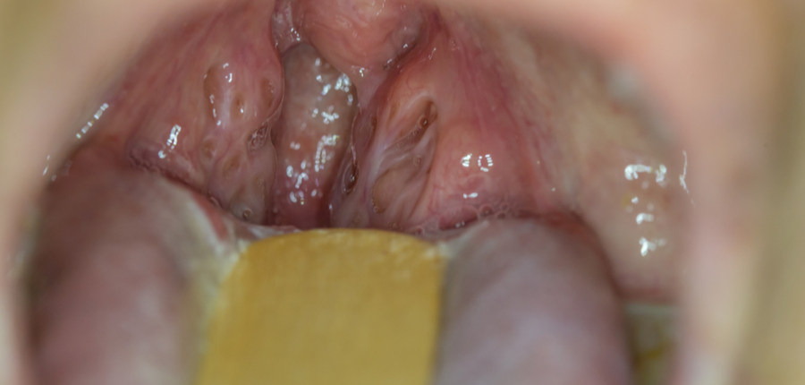 tonsil glands inflamed in a women