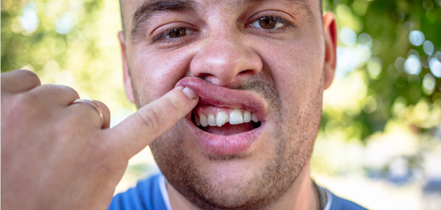 Unattractive chipped tooth of a man