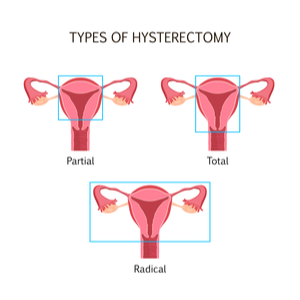 Hysterectomy types diagram